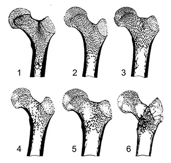 Trabecular rarefaction of bone is found with advancing age 
(1: young individual; 6: elderly individual)
Source: Luc Buchet, from Némeskéri et al. 1960.